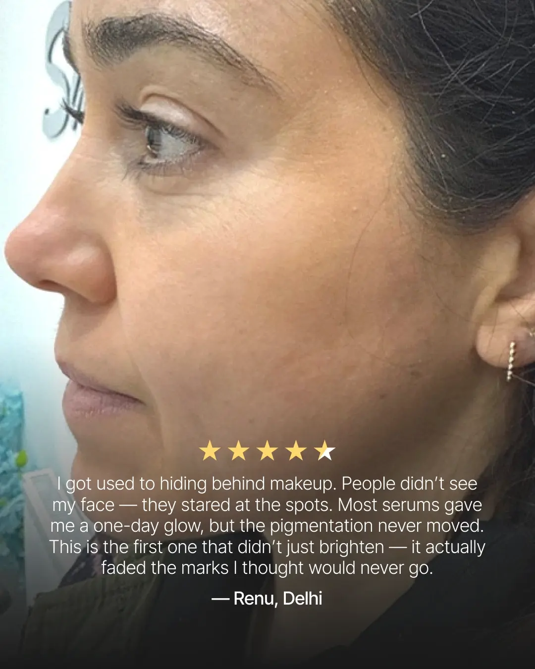 4-Week Hyperpigmentation Treatment - Image 9