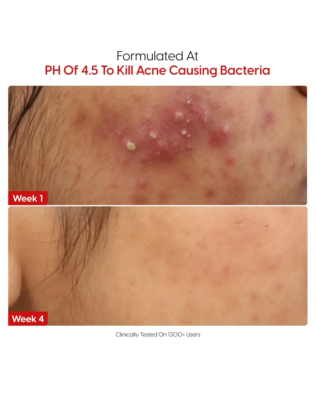 14% Pure Azelaic Acid Serum The Only Ingredient That Truly Ends Acne - Image 4