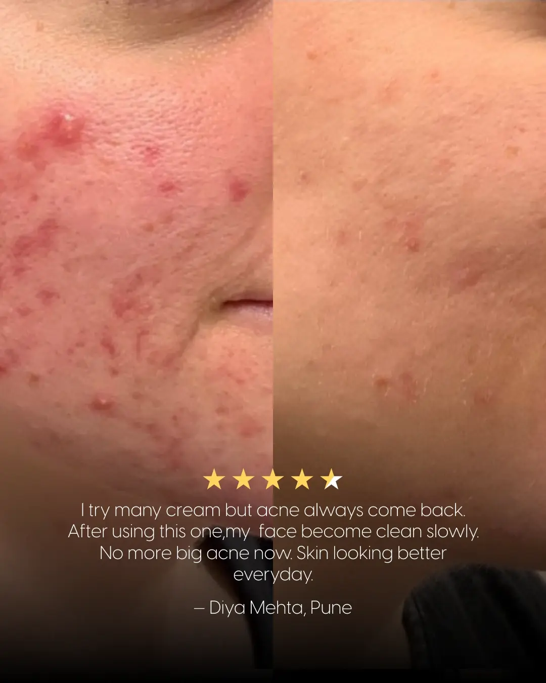 14% Pure Azelaic Acid Serum The Only Ingredient That Truly Ends Acne - Image 8