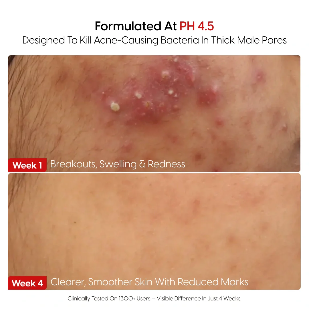 8% Pure Azelaic Acid Serum Ends Post-Shave Acne For Good - Image 4